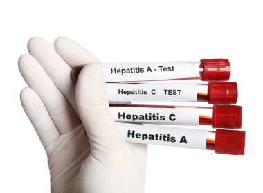 Bilim adamları, beyaz arka planda hepatit virüsü testi için kan örnekleri taşıyan tüpleri tutuyor.