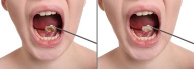 Beyaz arka plandaki diş plağının profesyonel tedavisinden önce ve sonra çekilmiş fotoğraflarıyla kolaj, yakın plan. Pankart tasarımı