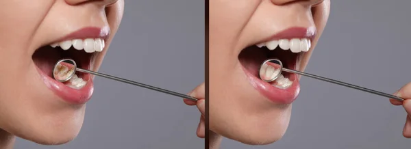 Colagem Com Fotos Mulher Antes Depois Tratamento Profissional Placa Dental — Fotografia de Stock