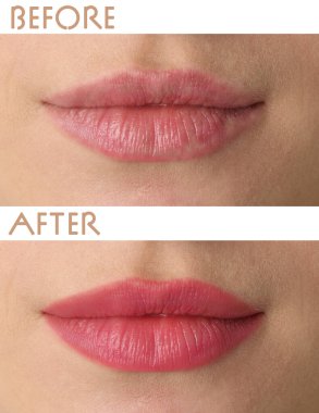 Dudak makyajından önce ve sonra genç bir kadının fotoğraflarıyla kolaj, yakın plan.