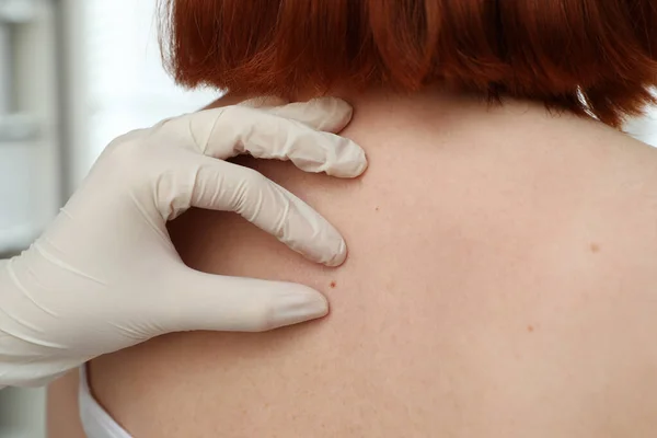 Dermatologe Untersucht Muttermal Des Patienten Klinik Nahaufnahme — Stockfoto