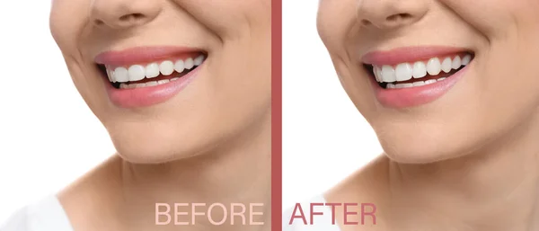 Beyaz Arka Planda Dişçilik Ameliyatından Önce Sonra Bir Kadın Yakın — Stok fotoğraf