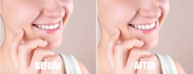 Bej arka planda dişçilik ameliyatından önce ve sonra genç bir kadın, yakın plan. Pankart tasarımı