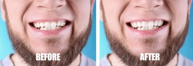 Açık mavi arka planda, dişçilik ameliyatından önce ve sonra genç adam, yakın plan. Pankart tasarımı