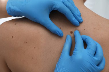 Dermatolog klinikte hastanın doğum lekesini inceliyor.