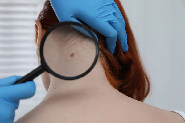 Dermatologista Examinando Marca Nascença Paciente Com Lupa Clínica Vista Perto — Fotografia de Stock