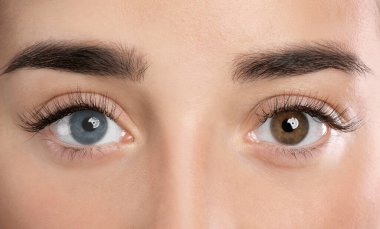 Woman with different colors of eyes, closeup. Heterochromia iridis clipart