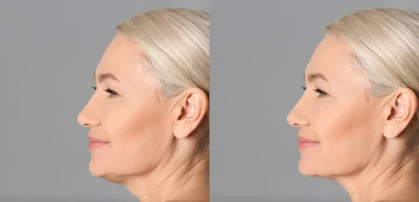 Double Chin Problem Collage Photos Mature Woman Plastic Surgery Procedure — Photo