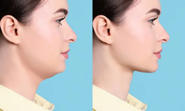 Double Chin Problem Collage Photos Young Woman Plastic Surgery Procedure — Photo