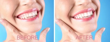 Açık mavi arka planda, dişçilik ameliyatından önce ve sonra genç bir kadın, yakın plan. Pankart tasarımı