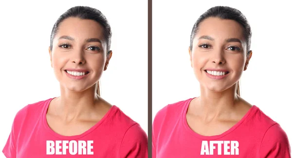 Beyaz Arka Planda Diş Cerrahisi Ameliyatından Önce Sonra Bir Kadın — Stok fotoğraf
