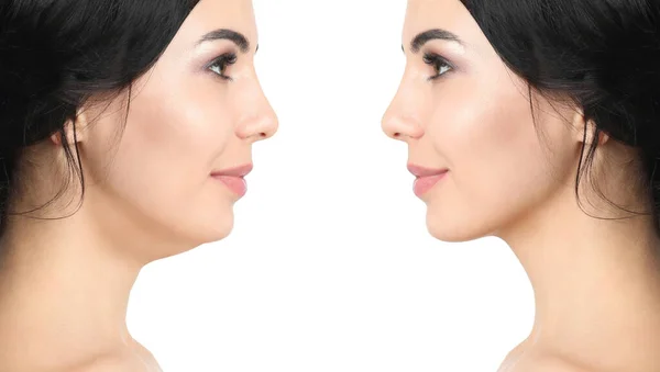 Double Chin Problem Collage Photos Young Woman Plastic Surgery Procedure — Fotografia de Stock