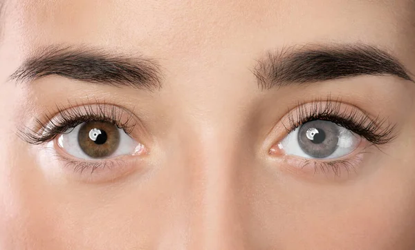 Woman Different Colors Eyes Closeup Heterochromia Iridis — Stock Photo, Image