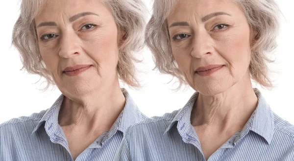 Проблема Двойным Подбородком Коллаж Фотографиями Зрелой Женщины После Пластической Операции — стоковое фото