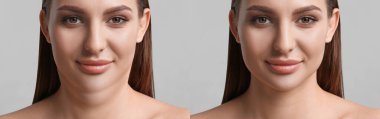 Double chin problem. Collage with photos of young woman before and after plastic surgery procedure on light grey background, banner design clipart