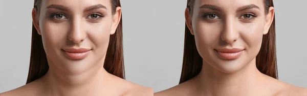 顎の二重問題 薄い灰色の背景にプラスチック手術前と後の若い女性の写真とコラージュ バナーデザイン — ストック写真