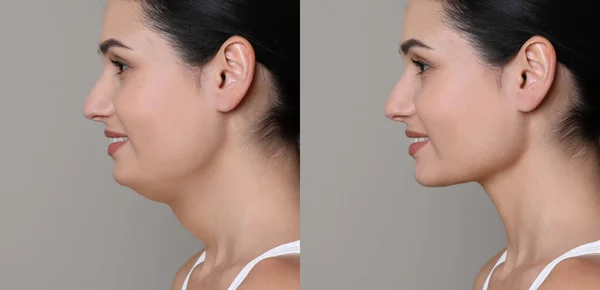 Double Chin Problem Collage Photos Young Woman Plastic Surgery Procedure —  Fotos de Stock