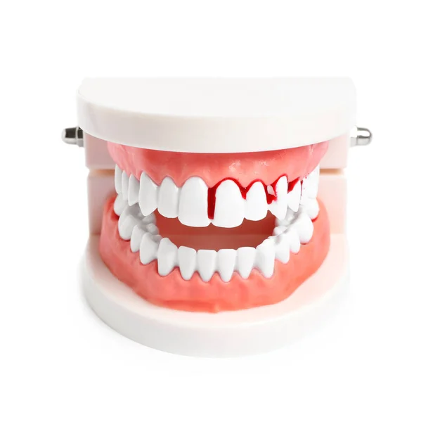 Model Jaw Blood Teeth White Background Gum Problems — Stock Photo, Image