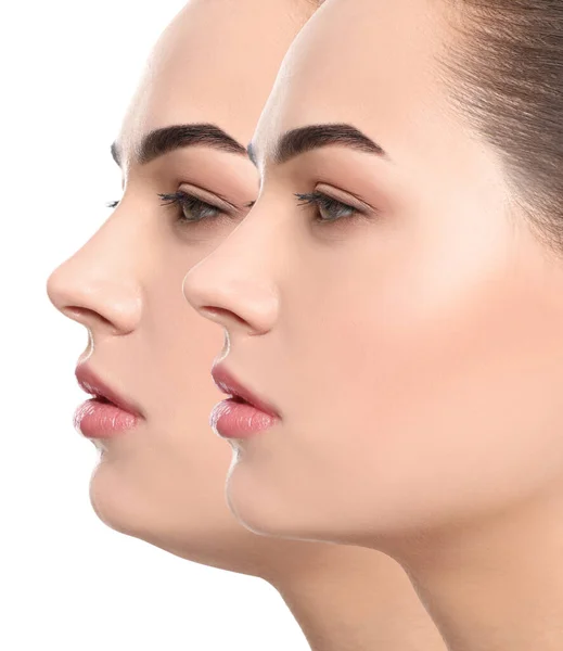 顎の二重問題 白地に形成外科手術前後の若い女性の写真とコラージュ — ストック写真