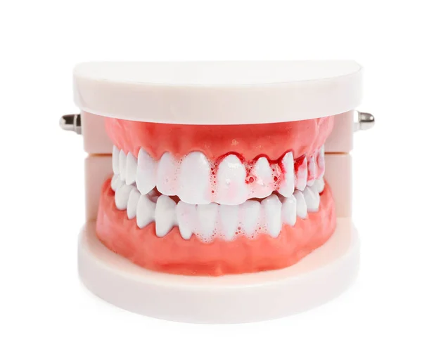 下颚和牙膏泡沫的模型 白底上有血迹 牙龈问题 — 图库照片
