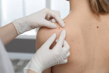 Dermatolog klinikte hastanın doğum lekesini inceliyor.