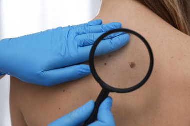 Dermatolog, klinikte büyüteçle hastanın doğum lekesini inceliyor.