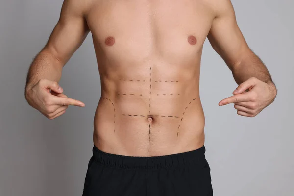 Fit Man Marks Body Grey Background Closeup Weight Loss Surgery — ストック写真
