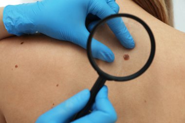 Dermatolog, klinikte büyüteçle hastanın doğum lekesini inceliyor.