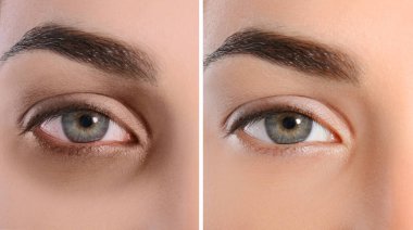 Collage with photos of tired woman with dark circle under eye and after rest, closeup
