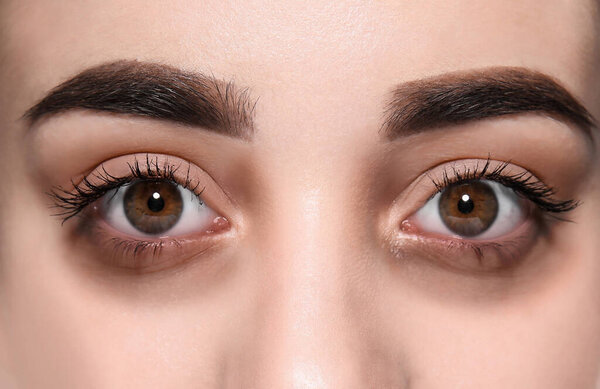 Tired young woman with dark circles under eyes, closeup