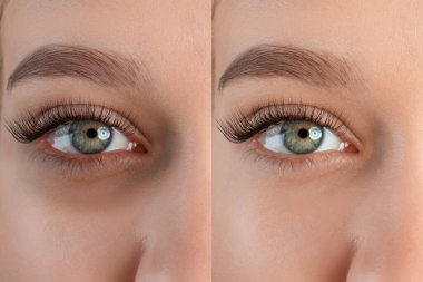 Göz altı koyu halkalı yorgun kadınların fotoğraflarıyla kolaj, ve dinlendikten sonra, yakın plan.