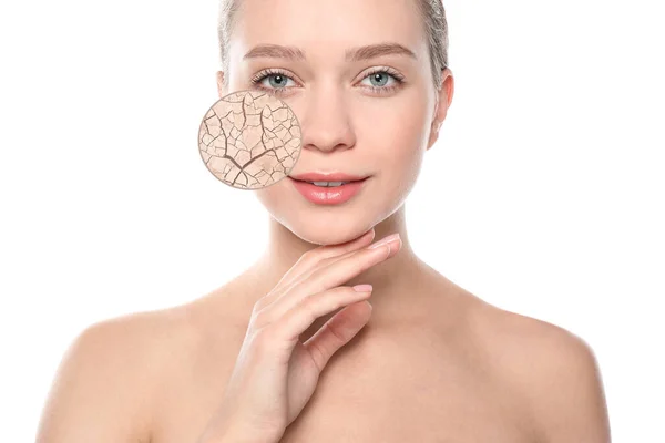 Young Woman Facial Dry Skin Problem White Background — Foto de Stock