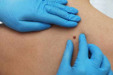 Dermatolog klinikte hastanın doğum lekesini inceliyor.