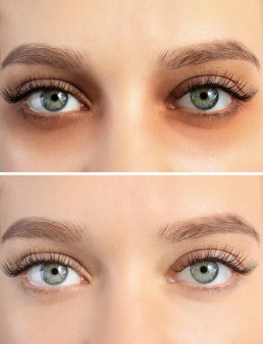 Collage with photos of tired woman with dark circle under eye and after rest, closeup