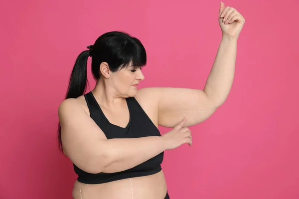 Fettleibige Frau Mit Schlaffem Arm Auf Rosa Hintergrund Operation Zur — Stockfoto