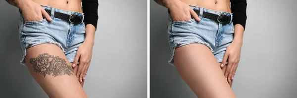 Mulher Antes Depois Procedimento Remoção Tatuagem Laser Fundo Cinza Claro — Fotografia de Stock