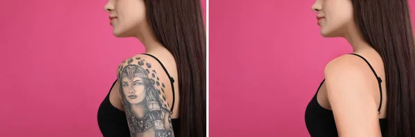 Woman Laser Tattoo Removal Procedure Pink Background Closeup Collage Photos — Stock Photo, Image