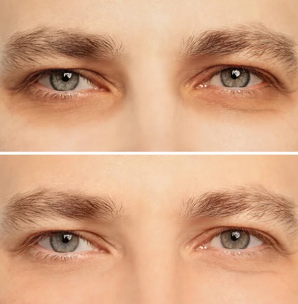 Colagem Com Fotos Homem Cansado Com Círculo Escuro Sob Olhos — Fotografia de Stock