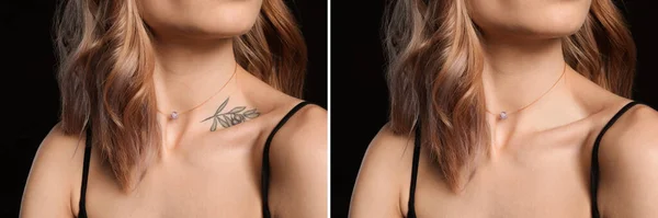 前と黒の背景にレーザータトゥー除去手順の後の女性 クローズアップ 写真付きコラージュ バナーデザイン — ストック写真
