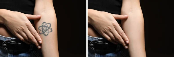 Vrouw Voor Laser Tatoeage Verwijderen Procedure Zwarte Achtergrond Close Collage — Stockfoto