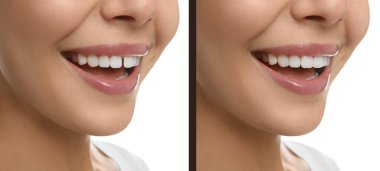 Beyaz arka planda tedaviden önce ve sonra ön dişleri arasında diyastemalı kadın fotoğrafları olan kolaj, yakın plan. Pankart tasarımı