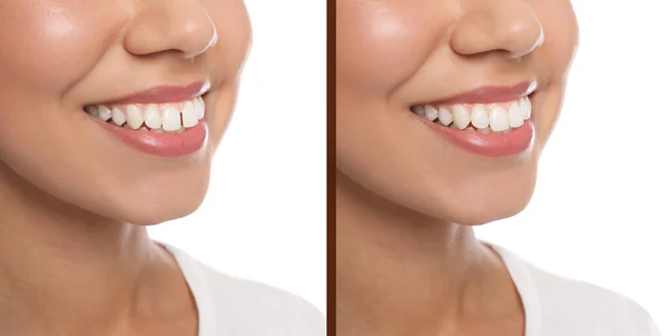 Collage Photos Woman Diastema Upper Front Teeth Treatment White Background — Stock Photo, Image