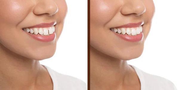 Collage Con Fotos Mujer Con Diastema Entre Los Dientes Delanteros — Foto de Stock