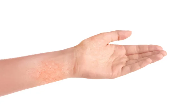 Γυναίκα Δείχνει Χέρι Ξηρό Δέρμα Λευκό Φόντο Closeup — Φωτογραφία Αρχείου