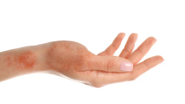 Γυναίκα Δείχνει Χέρι Ξηρό Δέρμα Λευκό Φόντο Closeup — Φωτογραφία Αρχείου