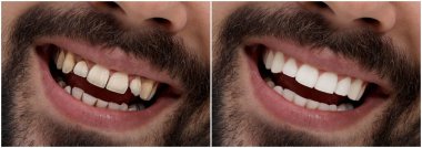 Diş tedavisi öncesi ve sonrası genç adamın fotoğraflarıyla kolaj, yakın plan. Pankart tasarımı