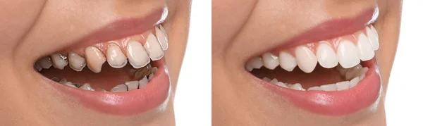 Collage Con Fotos Mujer Joven Antes Después Del Tratamiento Dental — Foto de Stock