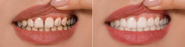 Collage Met Foto Van Jonge Vrouw Voor Tandheelkundige Behandeling Close — Stockfoto