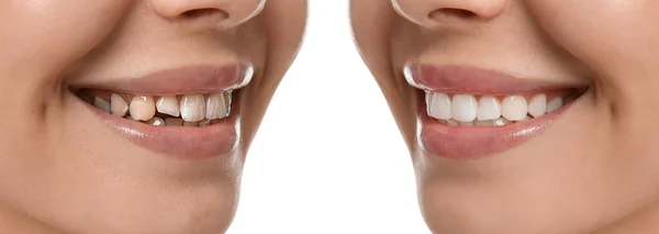 Collage Con Foto Giovane Donna Prima Dopo Trattamento Dentale Sfondo — Foto Stock