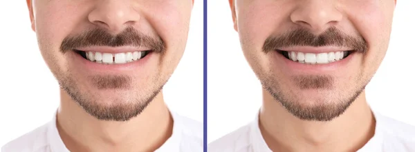 白い背景で治療前と治療後の上前の歯の間にジアステマを持つ男の写真とコラージュ クローズアップ バナーデザイン — ストック写真